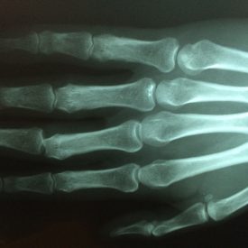 ¼ Ihrer Knochen sind in Ihrer Hand – schützen Sie sie!